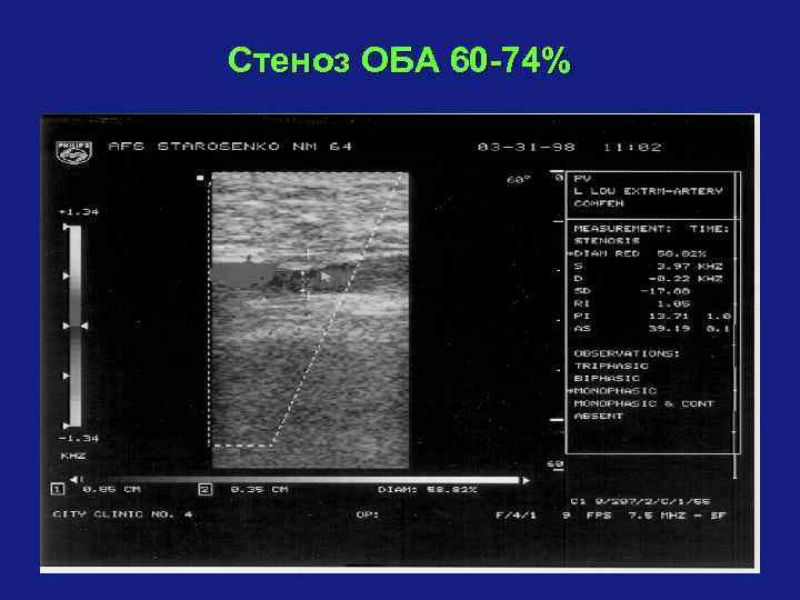 Стеноз ОБА 60 -74% 