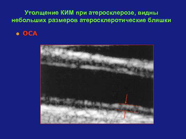 Утолщение КИМ при атеросклерозе, видны небольших размеров атеросклеротические бляшки l ОСА 