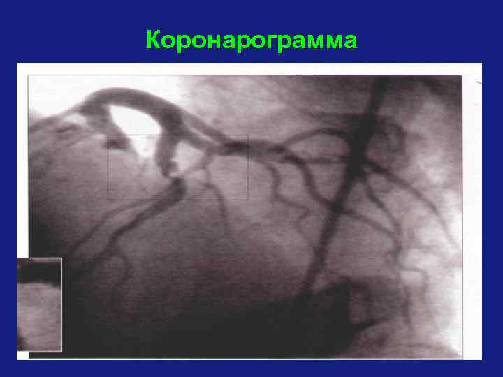 Коронарограмма 