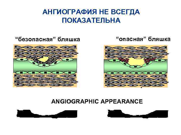 АНГИОГРАФИЯ НЕ ВСЕГДА ПОКАЗАТЕЛЬНА “безопасная” бляшка “опасная” бляшка ANGIOGRAPHIC APPEARANCE 