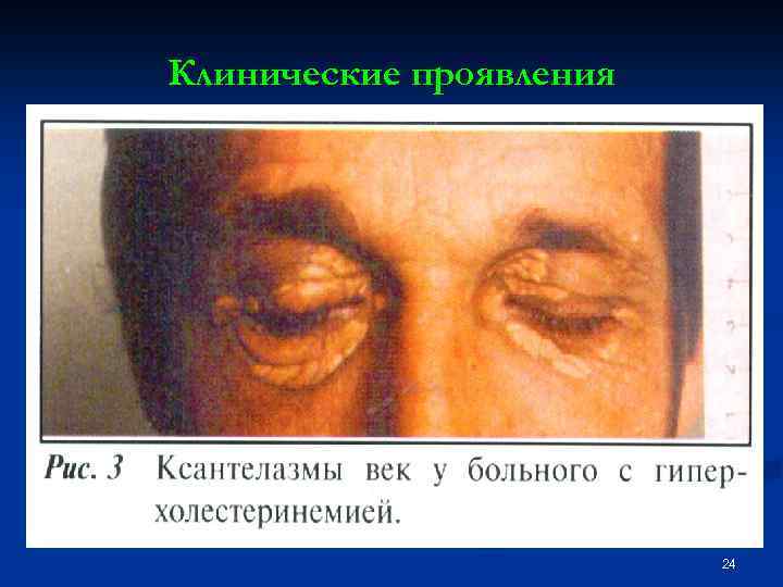 Клинические проявления 24 
