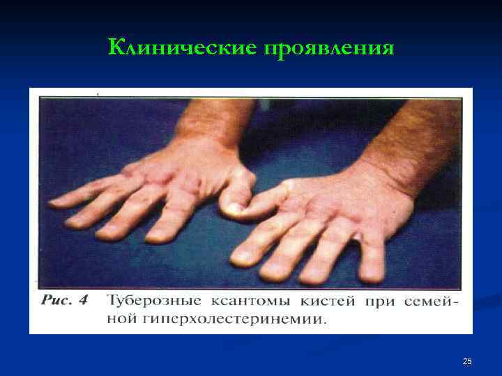 Клинические проявления 25 