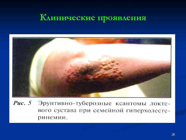 Клинические проявления 26 