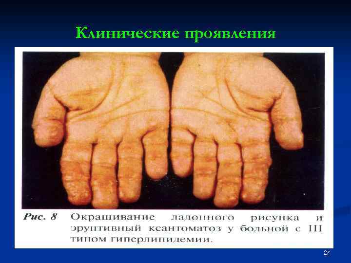 Клинические проявления 27 