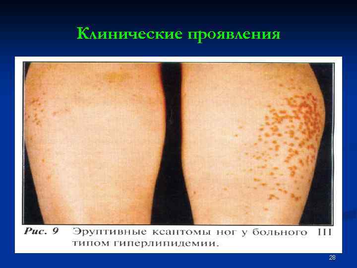 Клинические проявления 28 