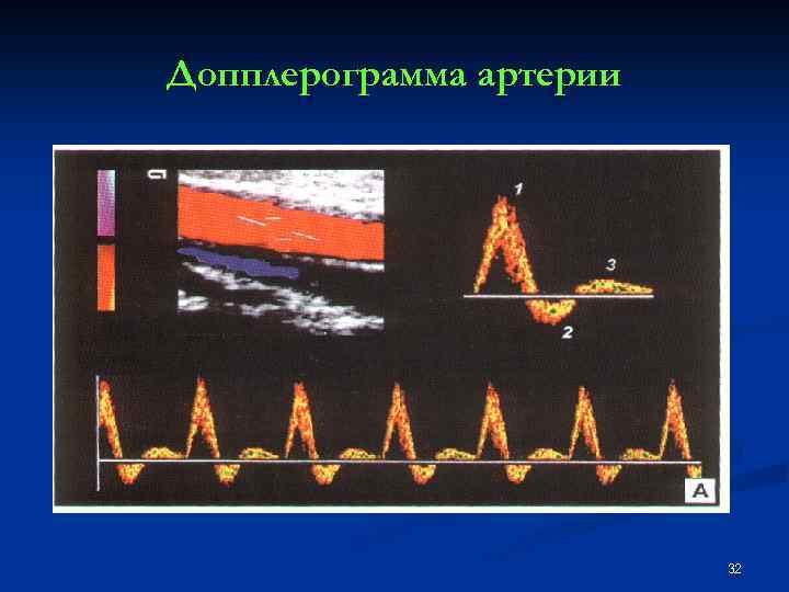 Допплерограмма артерии 32 