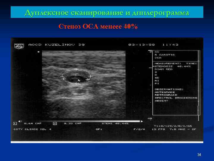 Дуплексное сканирование и дпплерограмма Стеноз ОСА менеее 40% 34 