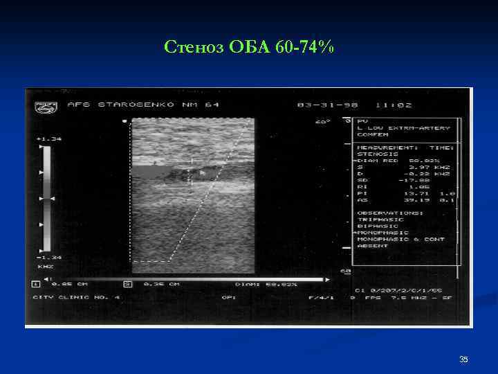 Стеноз ОБА 60 -74% 35 