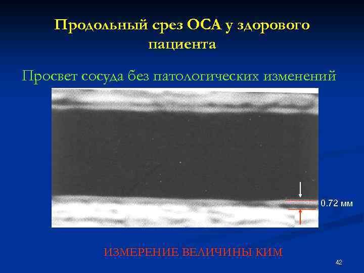 Продольный срез ОСА у здорового пациента Просвет сосуда без патологических изменений 0. 72 мм