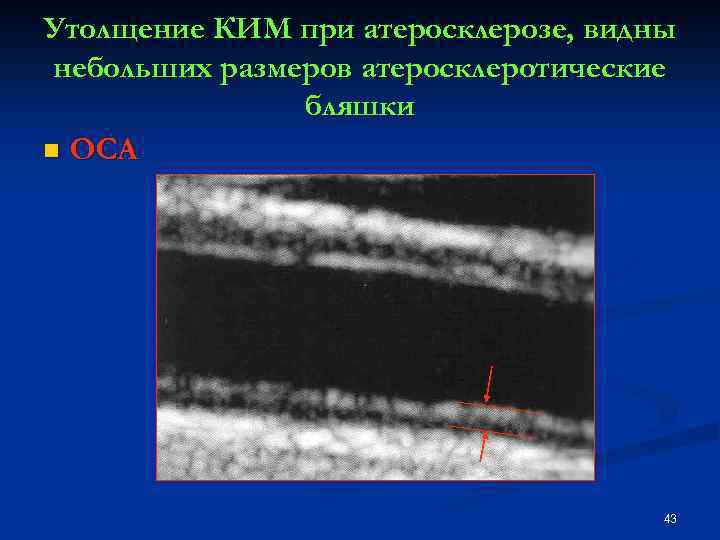Утолщение КИМ при атеросклерозе, видны небольших размеров атеросклеротические бляшки n ОСА 43 