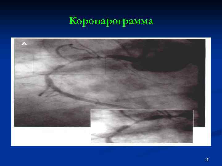 Коронарограмма 47 
