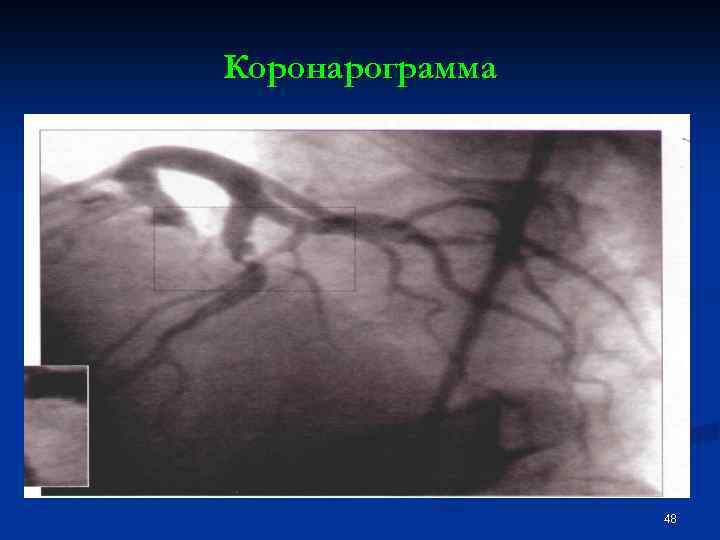 Коронарограмма 48 