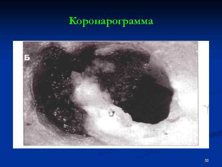 Коронарограмма 50 