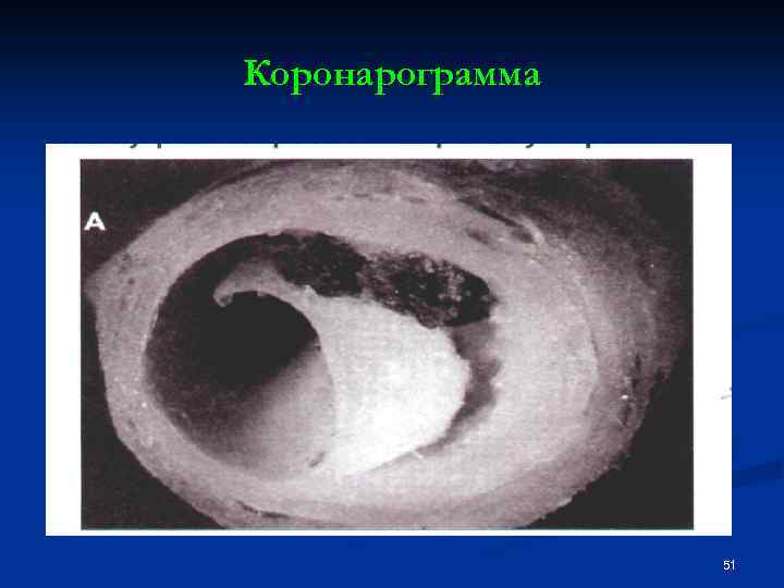 Коронарограмма 51 