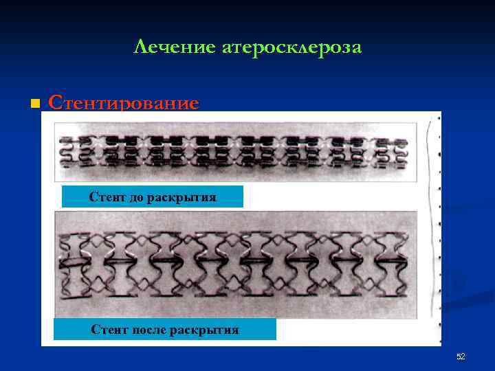 Лечение атеросклероза n Стентирование Стент до раскрытия Стент после раскрытия 52 