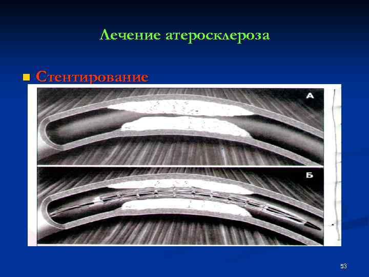 Лечение атеросклероза n Стентирование 53 