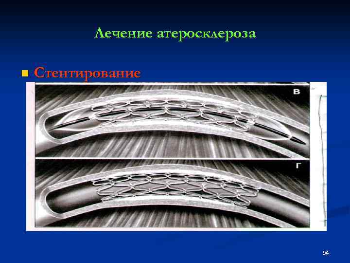 Лечение атеросклероза n Стентирование 54 