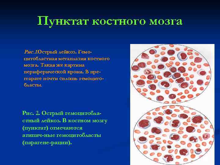 Пунктат костного мозга Рис. 1. Острый лейкоз. Гемоцитобластная метаплазия костного мозга. Такая же картина