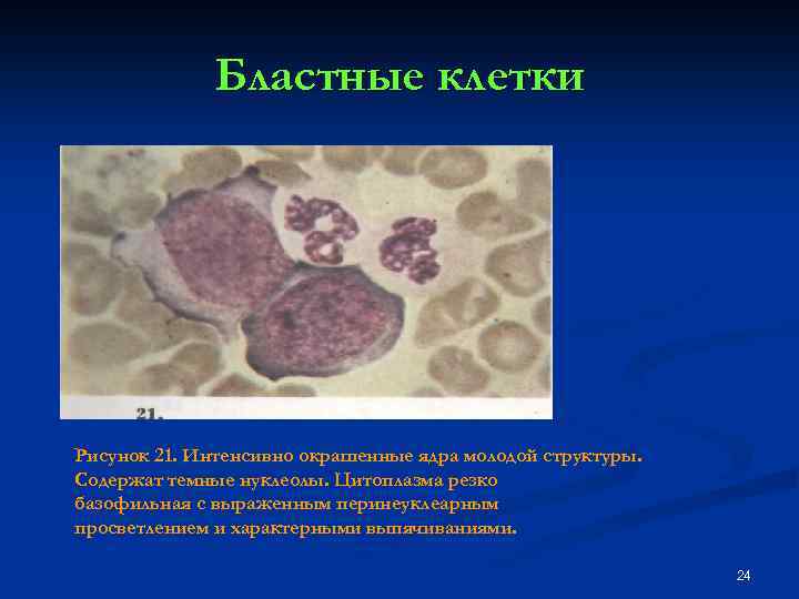 Бластные клетки Рисунок 21. Интенсивно окрашенные ядра молодой структуры. Содержат темные нуклеолы. Цитоплазма резко