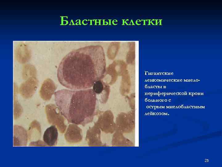 Бластные клетки Гигантские леикемические миелобласты в периферической крови больного с острым миелобластным лейкозом. 25