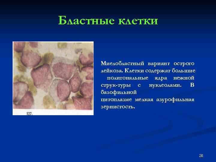 Бластные клетки Миелобластный вариант острого лейкоза. Клетки содержат большие полигональные ядра нежной струк туры