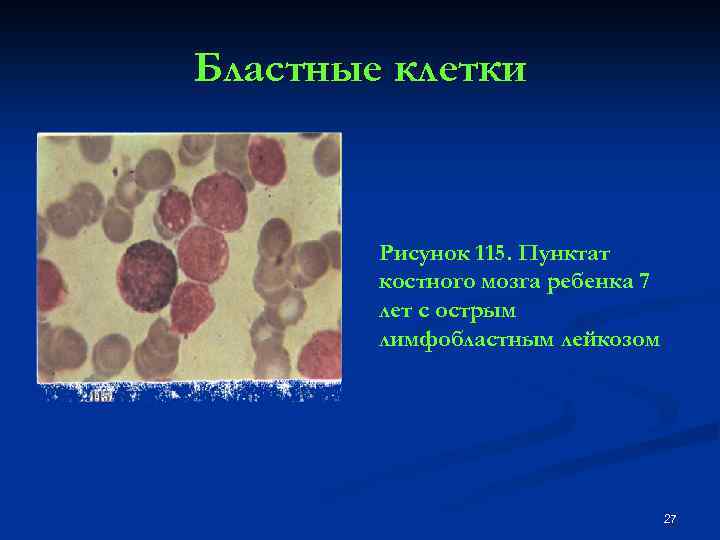 Бластные клетки Рисунок 115. Пунктат костного мозга ребенка 7 лет с острым лимфобластным лейкозом