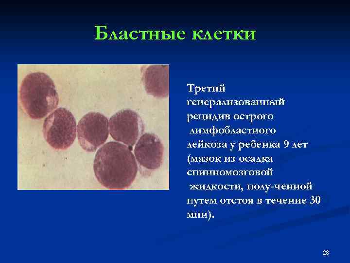 Бластные клетки Третий генерализованный рецидив острого лимфобластного лейкоза у ребенка 9 лет (мазок из