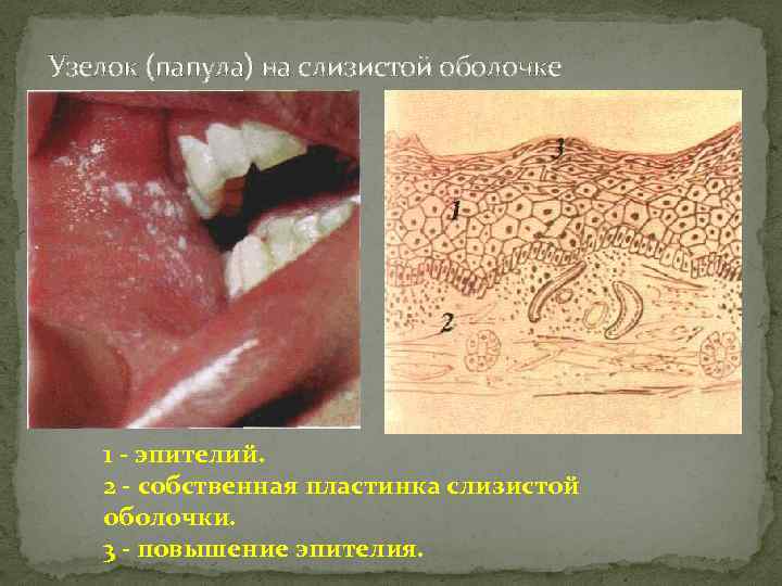 Туберкулез слизистой оболочки полости рта презентация