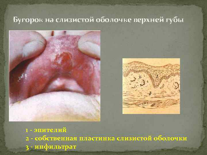 Бугорок на слизистой оболочке верхней губы 1 - эпителий 2 - собственная пластинка слизистой