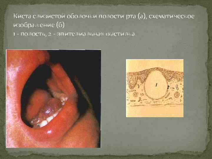 Киста на слизистой рта фото
