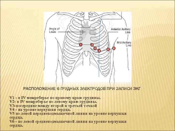 Схема расположения электродов экг