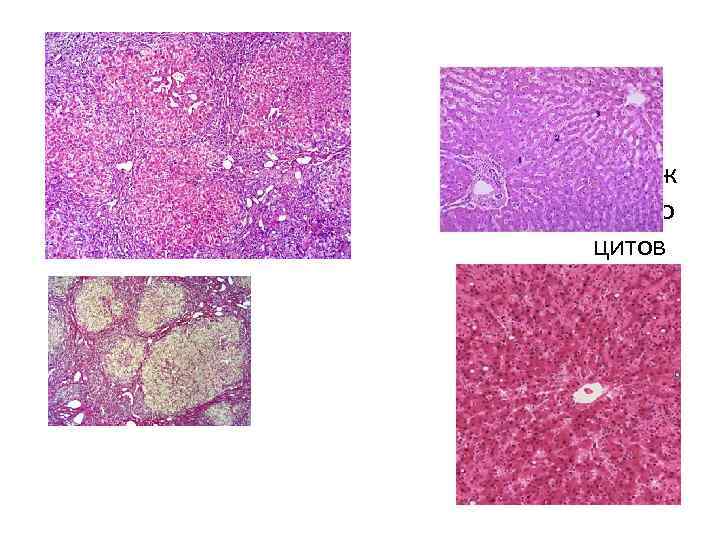 • Пораж гепато цитов в центр е и по периф ерии 