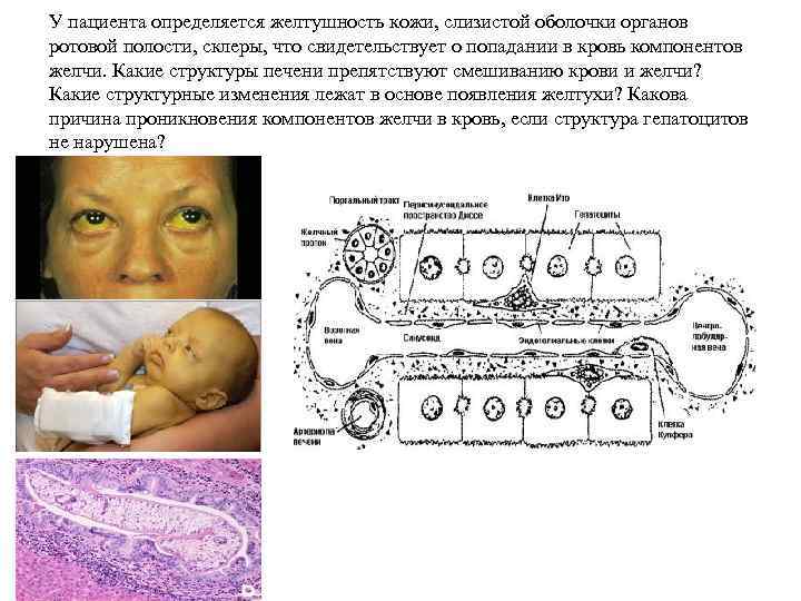 У пациента определяется желтушность кожи, слизистой оболочки органов ротовой полости, склеры, что свидетельствует о