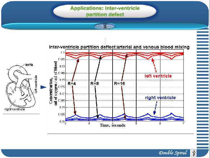 Applications: Inter-ventricle partition defect 