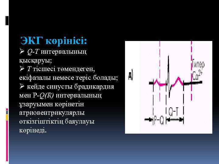 ЭКГ көрінісі: Ø Q-T интервалының қысқаруы; Ø Т тісшесі төмендеген, екіфазалы немесе теріс болады;