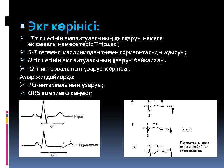  Экг көрінісі: Т тісшесінің амплитудасының қысқаруы немесе екіфазалы немесе теріс Т тісшесі; Ø