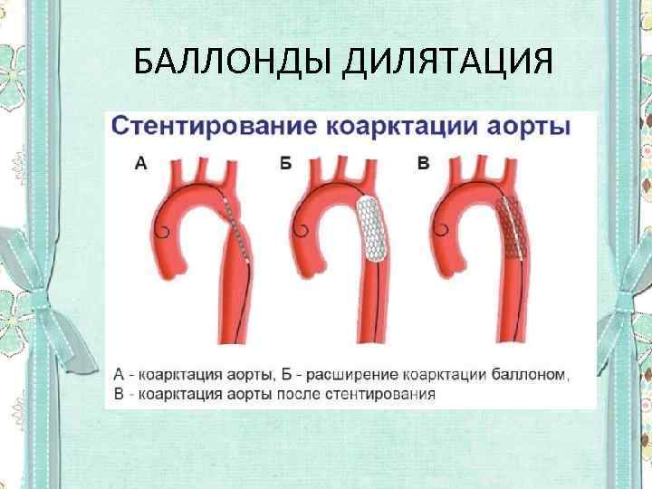 БАЛЛОНДЫ ДИЛЯТАЦИЯ 