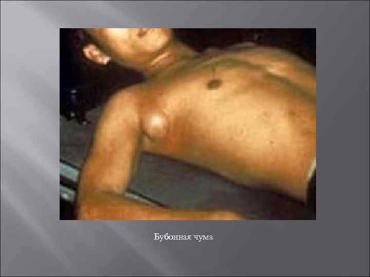 Бубонная чума 