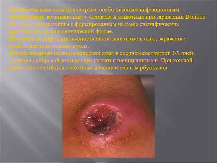 Сибирская язва является острым, особо опасным инфекционным заболеванием, возникающим у человека и животных при