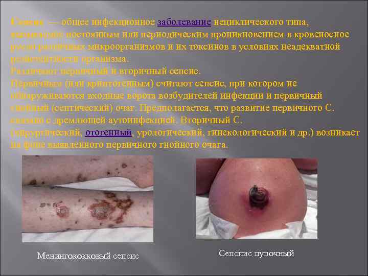 Сепсис — общее инфекционное заболевание нециклического типа, вызываемое постоянным или периодическим проникновением в кровеносное