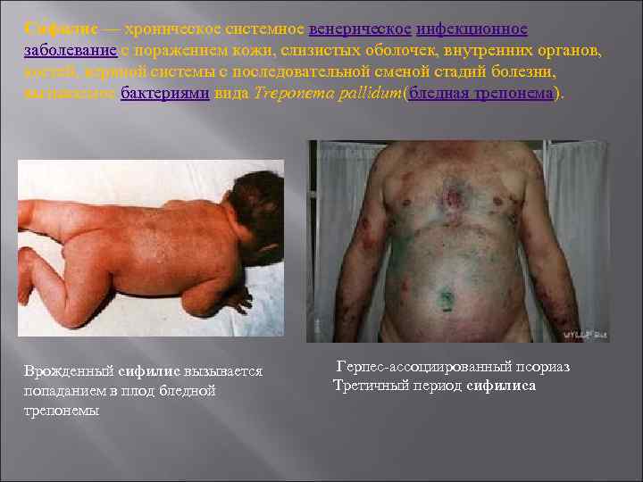 Си филис — хроническое системное венерическое инфекционное заболевание с поражением кожи, слизистых оболочек, внутренних