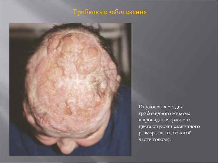 Грибковые заболевания Опухолевая стадия грибовидного микоза: шаровидные красного цвета опухоли различного размера на волосистой
