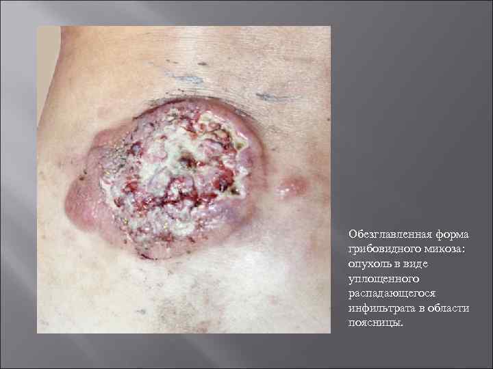 Обезглавленная форма грибовидного микоза: опухоль в виде уплощенного распадающегося инфильтрата в области поясницы. 