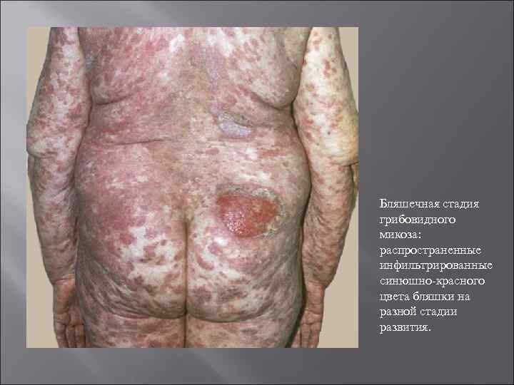 Бляшечная стадия грибовидного микоза: распространенные инфильтрированные синюшно-красного цвета бляшки на разной стадии развития. 