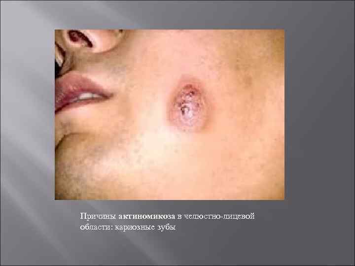 Причины актиномикоза в челюстно-лицевой области: кариозные зубы 