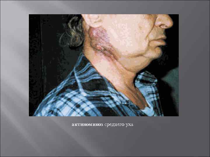 актиномикоз среднего уха 