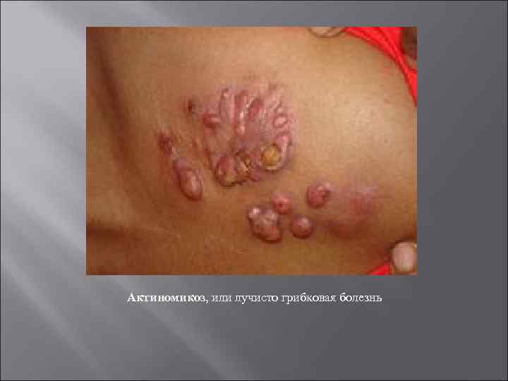 Актиномикоз, или лучисто грибковая болезнь 