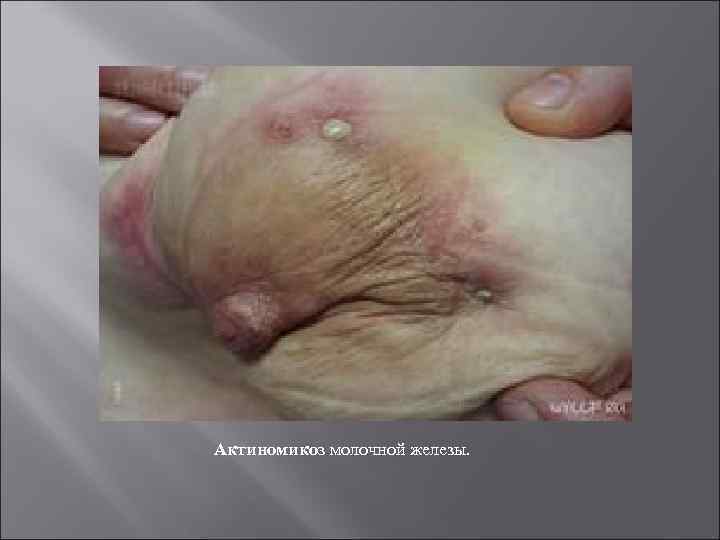 Актиномикоз молочной железы. 