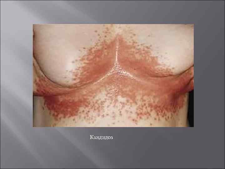 Кандидоз 