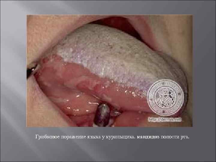 Грибковое поражение языка у курильщика. кандидоз полости рта. 